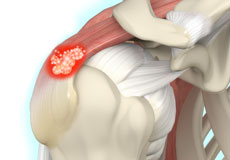 Calcification Tendonitis of the Shoulder
