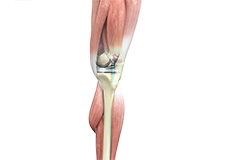 Outpatient Total Knee Replacement 