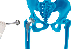 Mako Robotic-Arm Assisted Total Hip Replacement