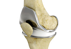 Total Knee Replacement (TKR)